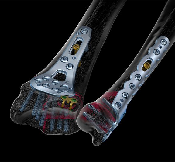 Ortopedik Plak ve Vida Sistemleri (Plates & Screws)