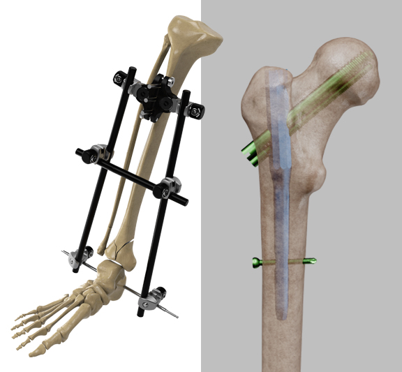 Nail System ve Fiksatörler (Intramedüller Çivi & Eksternal Fiksasyon)