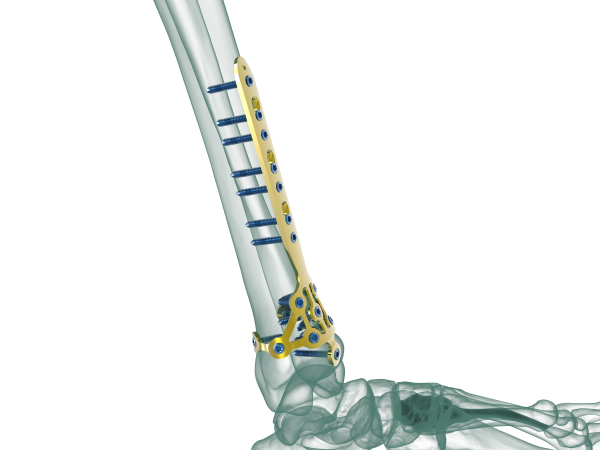 Distal Fibula (Ayak Bileği)